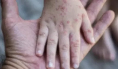 Efectos en la piel por la 'viruela del mono'.