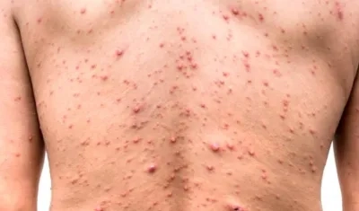 Efectos de la viruela del mono.