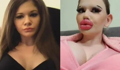 Andrea Ivanova en una foto de antes y después de los procedimientos para engrosar sus labios.