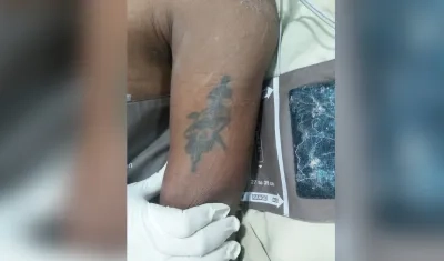 Brazo izquierdo del paciente