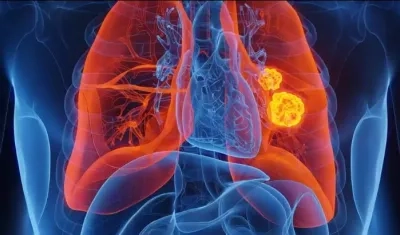 El cáncer de pulmón es la primera causa de muerte por cáncer a nivel mundial 