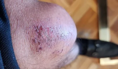 Así quedó la rodilla del Presidente Gustavo Petro.