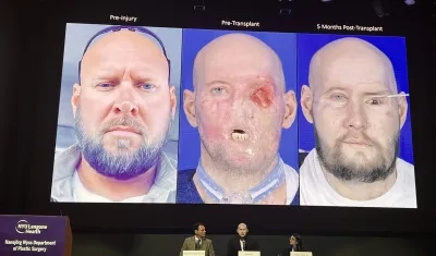 Los especialistas explican el procedimiento en el paciente Aaron James