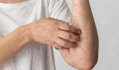 Imagen de referencia de la viruela del mono.