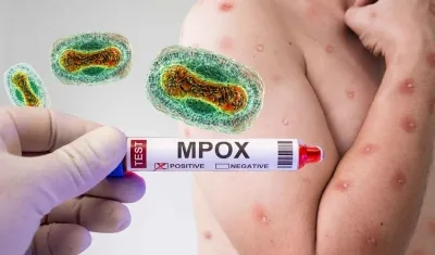 Mpox. 