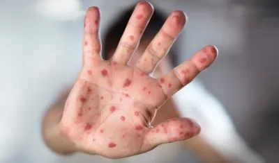 Imagen de referencia de sarampión.