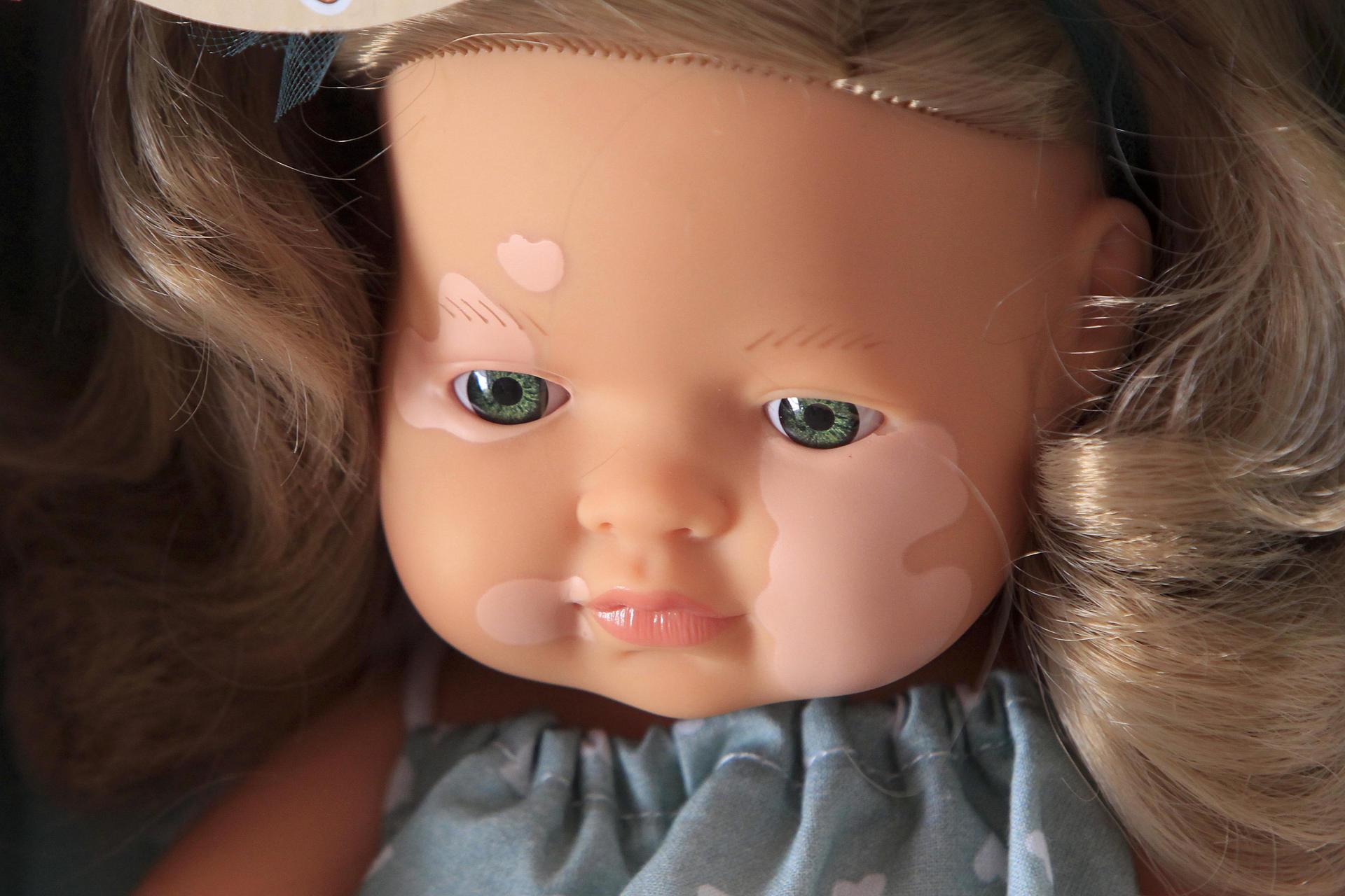 Muñeca con vitíligo. 